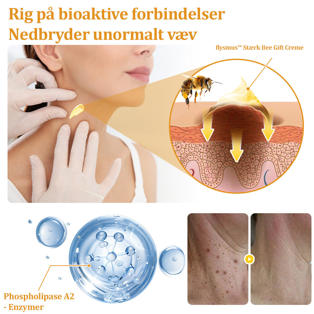 🐝 flysmus™ Starke Bienengiftcreme, zertifiziert von der Dänischen Dermatologischen Gesellschaft (DDS) - Hilft bei hartnäckigen Warzen, Hautwucherungen, Hautläsionen, Infektionen, Narbenbildung und gleicht Unebenheiten aus hud👨⚕️