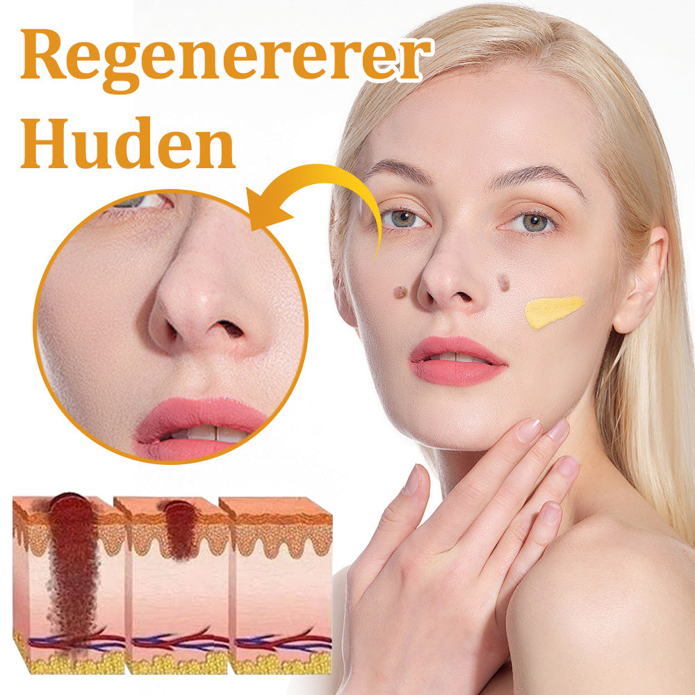 🐝 flysmus™ Starke Bienengiftcreme, zertifiziert von der Dänischen Dermatologischen Gesellschaft (DDS) - Hilft bei hartnäckigen Warzen, Hautwucherungen, Hautläsionen, Infektionen, Narbenbildung und gleicht Unebenheiten aus hud👨⚕️