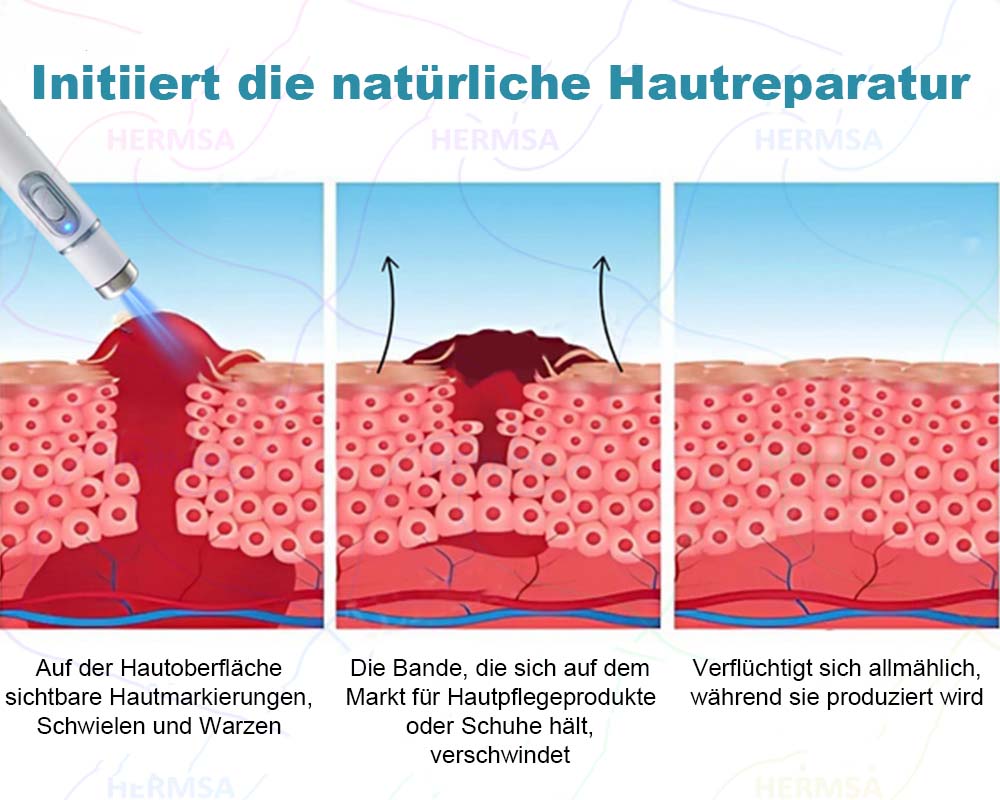 Hermsa® nicht-invasiver Laserpointer - Muttermal- und Warzenentfernung (🔥Letzter Tag 80% Rabatt)