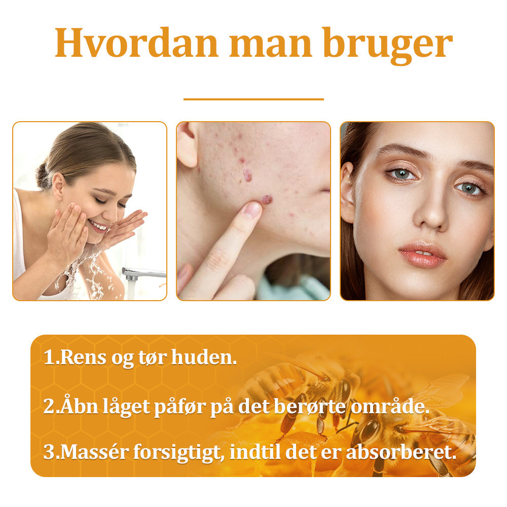 🐝 flysmus™ Starke Bienengiftcreme, zertifiziert von der Dänischen Dermatologischen Gesellschaft (DDS) - Hilft bei hartnäckigen Warzen, Hautwucherungen, Hautläsionen, Infektionen, Narbenbildung und gleicht Unebenheiten aus hud👨⚕️