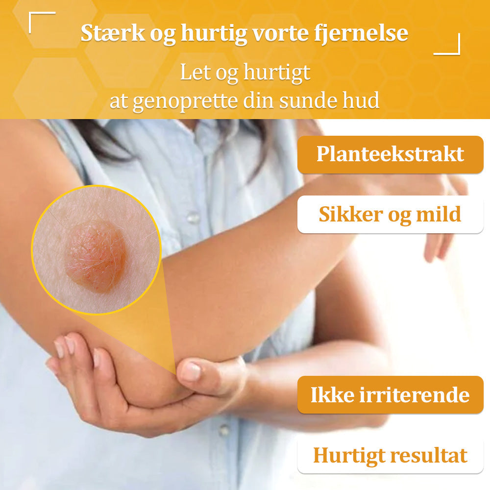 🐝 flysmus™ Starke Bienengiftcreme, zertifiziert von der Dänischen Dermatologischen Gesellschaft (DDS) - Hilft bei hartnäckigen Warzen, Hautwucherungen, Hautläsionen, Infektionen, Narbenbildung und gleicht Unebenheiten aus hud👨⚕️