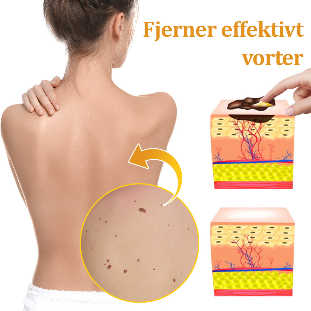 🐝 flysmus™ Starke Bienengiftcreme, zertifiziert von der Dänischen Dermatologischen Gesellschaft (DDS) - Hilft bei hartnäckigen Warzen, Hautwucherungen, Hautläsionen, Infektionen, Narbenbildung und gleicht Unebenheiten aus hud👨⚕️