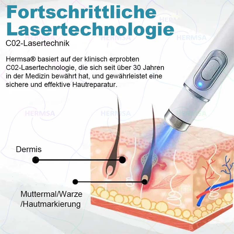 Hermsa® nicht-invasiver Laserpointer - Muttermal- und Warzenentfernung (🔥Letzter Tag 80% Rabatt)