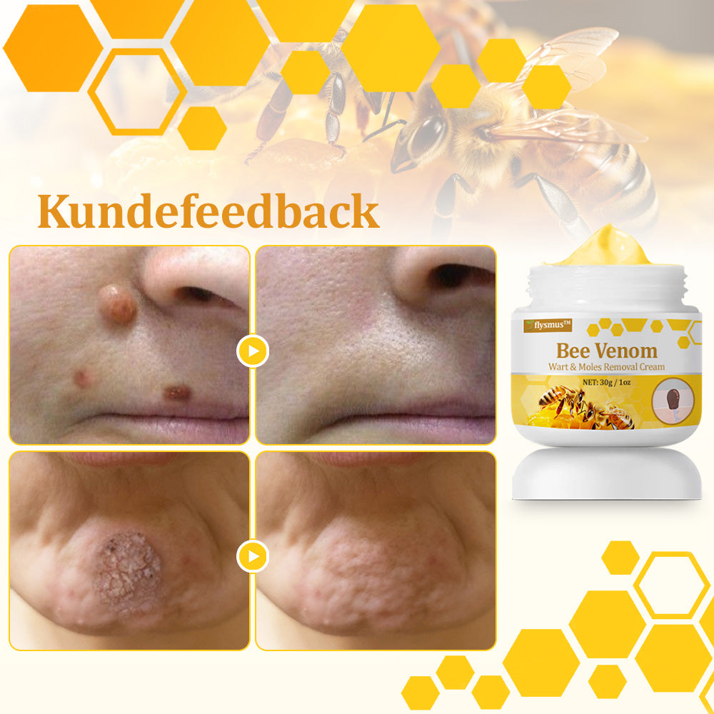 🐝 flysmus™ Starke Bienengiftcreme, zertifiziert von der Dänischen Dermatologischen Gesellschaft (DDS) - Hilft bei hartnäckigen Warzen, Hautwucherungen, Hautläsionen, Infektionen, Narbenbildung und gleicht Unebenheiten aus hud👨⚕️