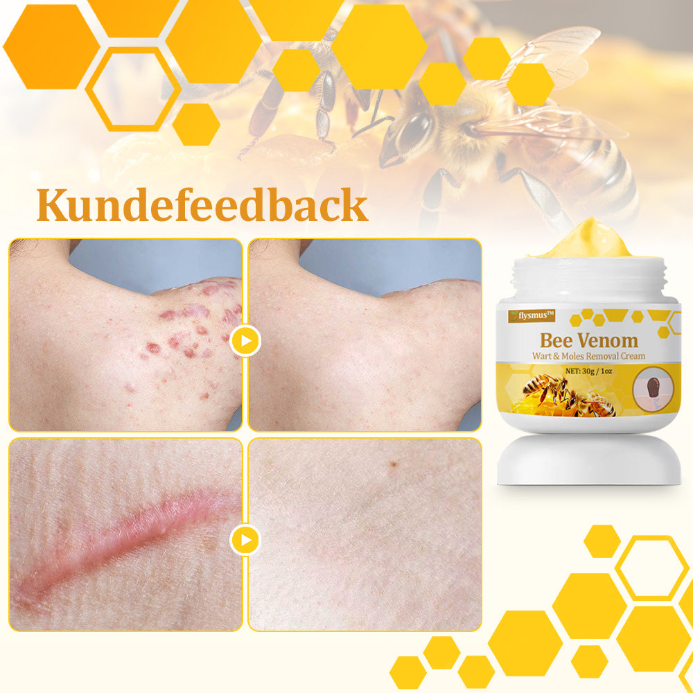 🐝 flysmus™ Starke Bienengiftcreme, zertifiziert von der Dänischen Dermatologischen Gesellschaft (DDS) - Hilft bei hartnäckigen Warzen, Hautwucherungen, Hautläsionen, Infektionen, Narbenbildung und gleicht Unebenheiten aus hud👨⚕️