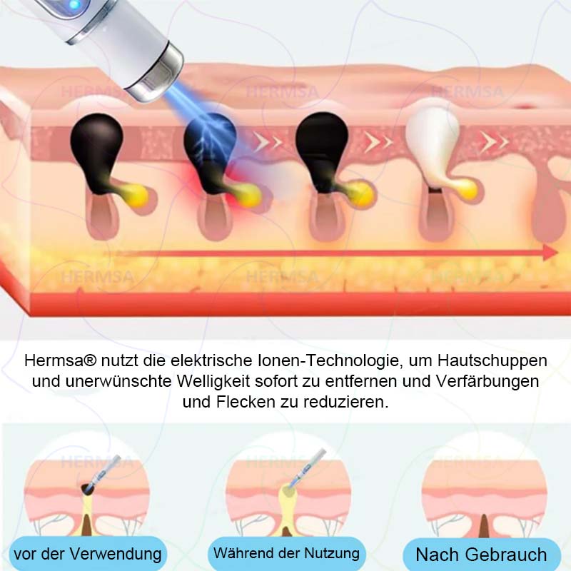 Hermsa® nicht-invasiver Laserpointer - Muttermal- und Warzenentfernung (🔥Letzter Tag 80% Rabatt)