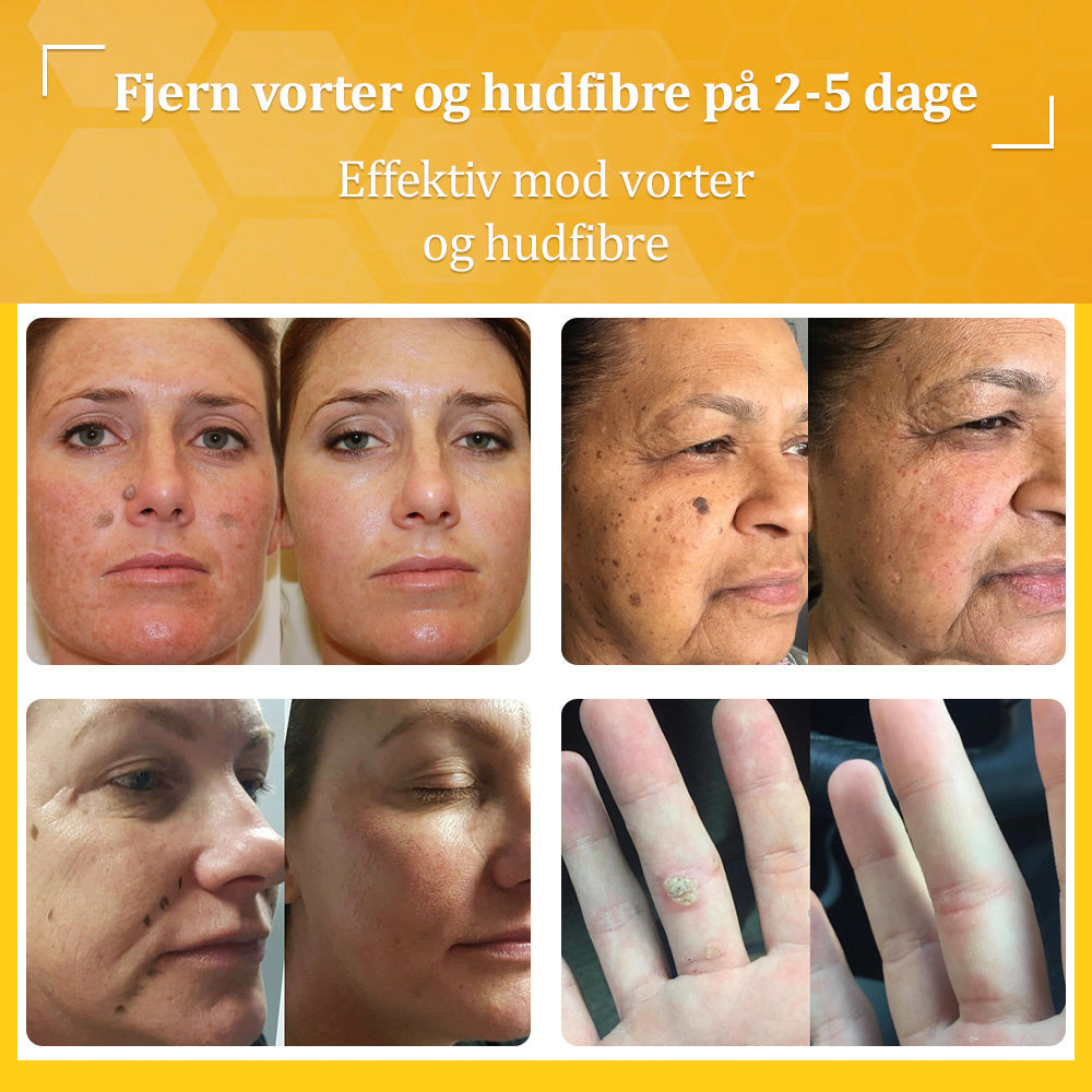 🐝 flysmus™ Starke Bienengiftcreme, zertifiziert von der Dänischen Dermatologischen Gesellschaft (DDS) - Hilft bei hartnäckigen Warzen, Hautwucherungen, Hautläsionen, Infektionen, Narbenbildung und gleicht Unebenheiten aus hud👨⚕️