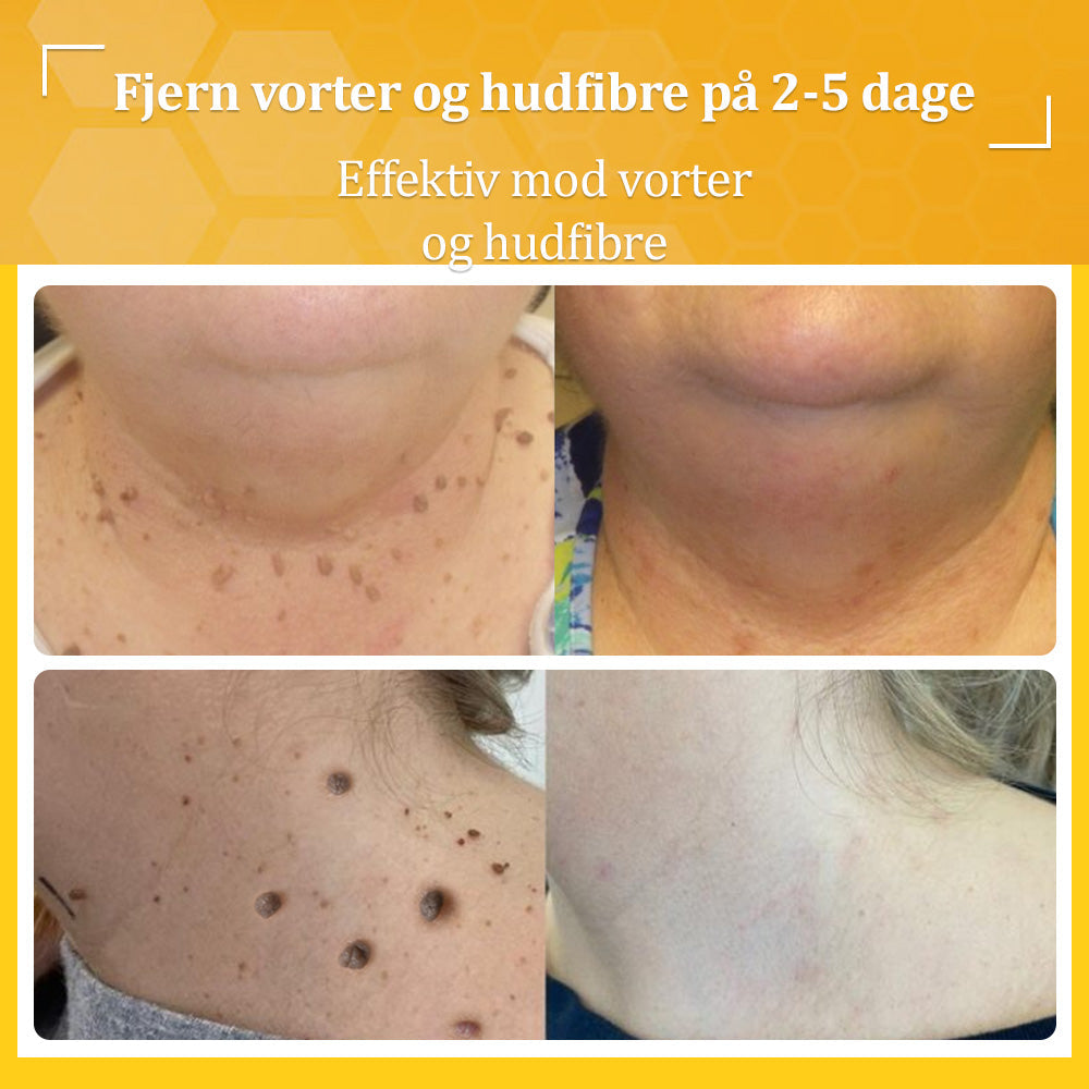 🐝 flysmus™ Starke Bienengiftcreme, zertifiziert von der Dänischen Dermatologischen Gesellschaft (DDS) - Hilft bei hartnäckigen Warzen, Hautwucherungen, Hautläsionen, Infektionen, Narbenbildung und gleicht Unebenheiten aus hud👨⚕️