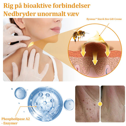 🐝 flysmus™ Starke Bienengiftcreme, zertifiziert von der Dänischen Dermatologischen Gesellschaft (DDS) - Hilft bei hartnäckigen Warzen, Hautwucherungen, Hautläsionen, Infektionen, Narbenbildung und gleicht Unebenheiten aus hud👨‍⚕️