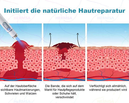 Hermsa® nicht-invasiver Laserpointer - Muttermal- und Warzenentfernung (🔥Letzter Tag 80% Rabatt)