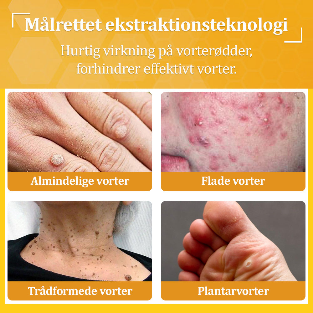 🐝 flysmus™ Starke Bienengiftcreme, zertifiziert von der Dänischen Dermatologischen Gesellschaft (DDS) - Hilft bei hartnäckigen Warzen, Hautwucherungen, Hautläsionen, Infektionen, Narbenbildung und gleicht Unebenheiten aus hud👨‍⚕️