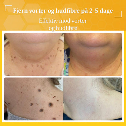 🐝 flysmus™ Starke Bienengiftcreme, zertifiziert von der Dänischen Dermatologischen Gesellschaft (DDS) - Hilft bei hartnäckigen Warzen, Hautwucherungen, Hautläsionen, Infektionen, Narbenbildung und gleicht Unebenheiten aus hud👨‍⚕️